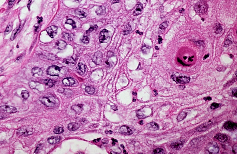 Well_differentiated_squamous_cell_carcinoma