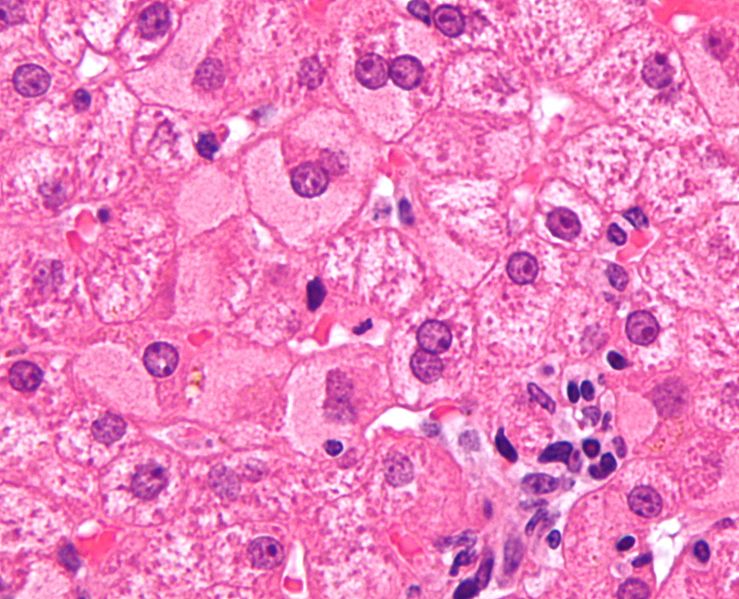 739px-Ground_glass_hepatocytes_high_mag_cropped_2