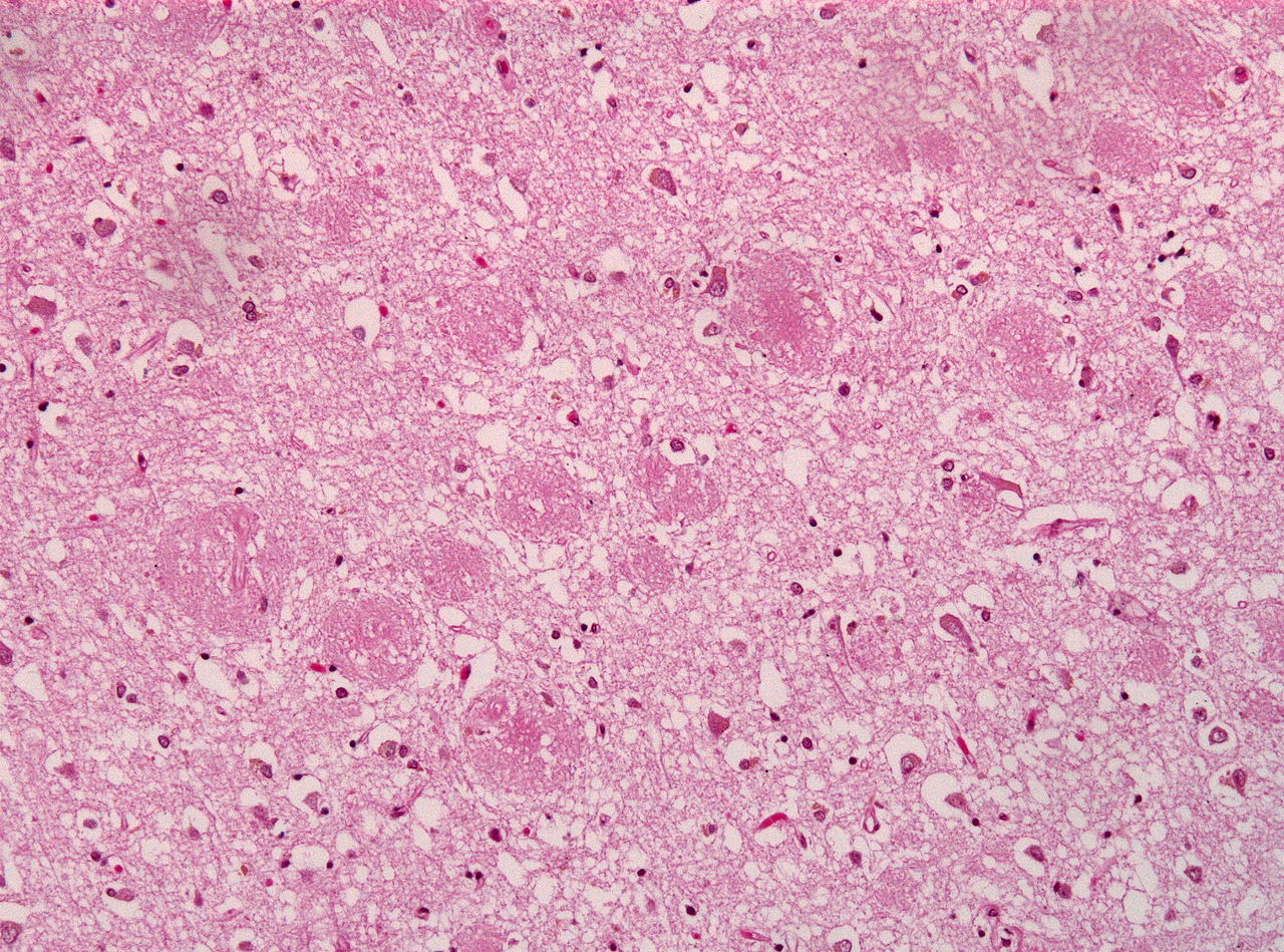 1280px-Amyloid_plaques_alzheimer_disease_HE_stain