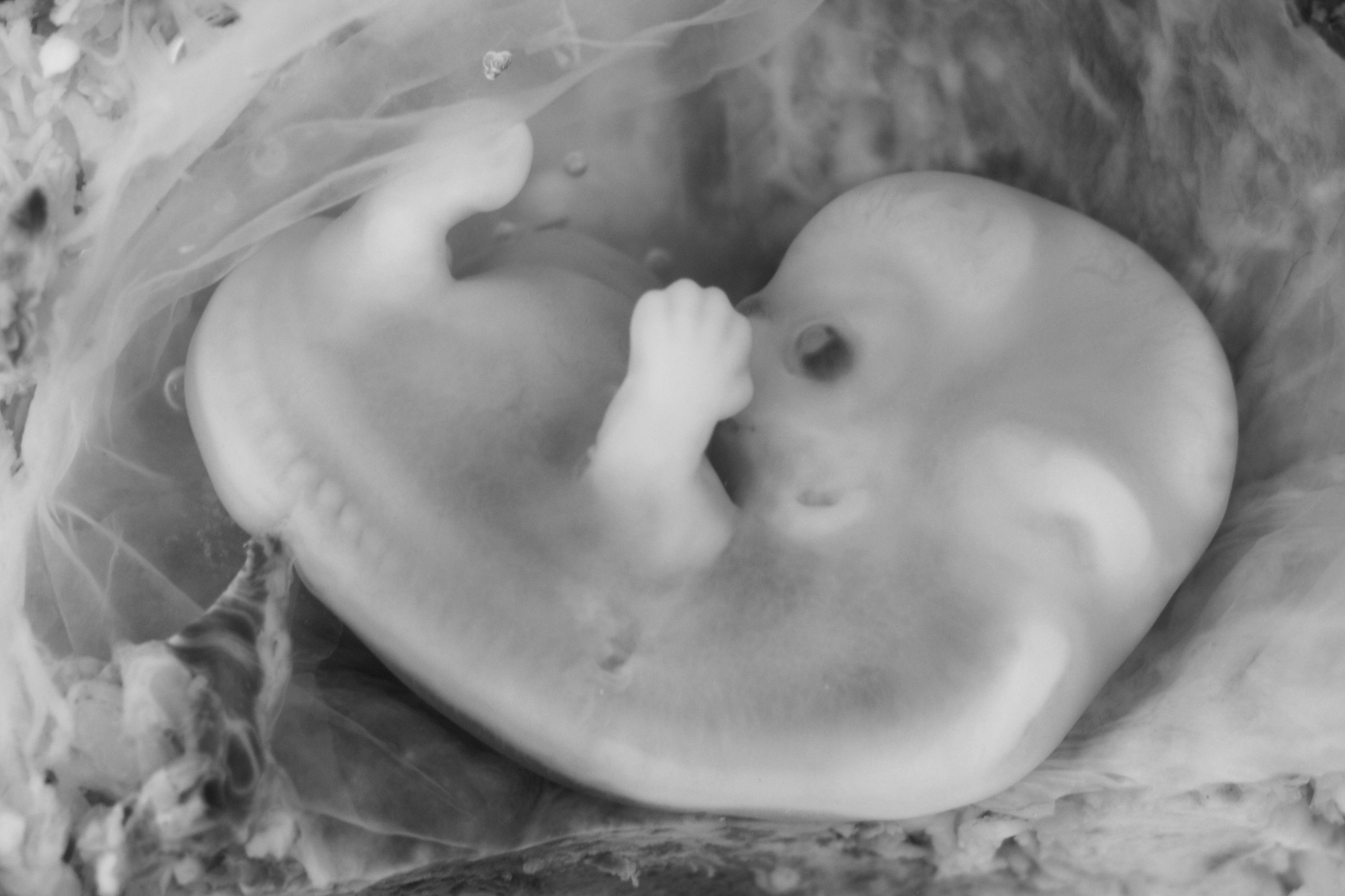 9-Week_Human_Embryo_from_Ectopic_Pregnancy