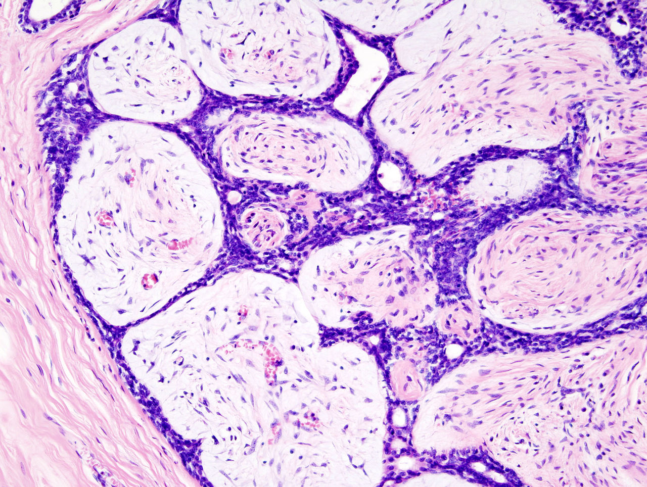 1280px-Breast_fibradenoma_(1)