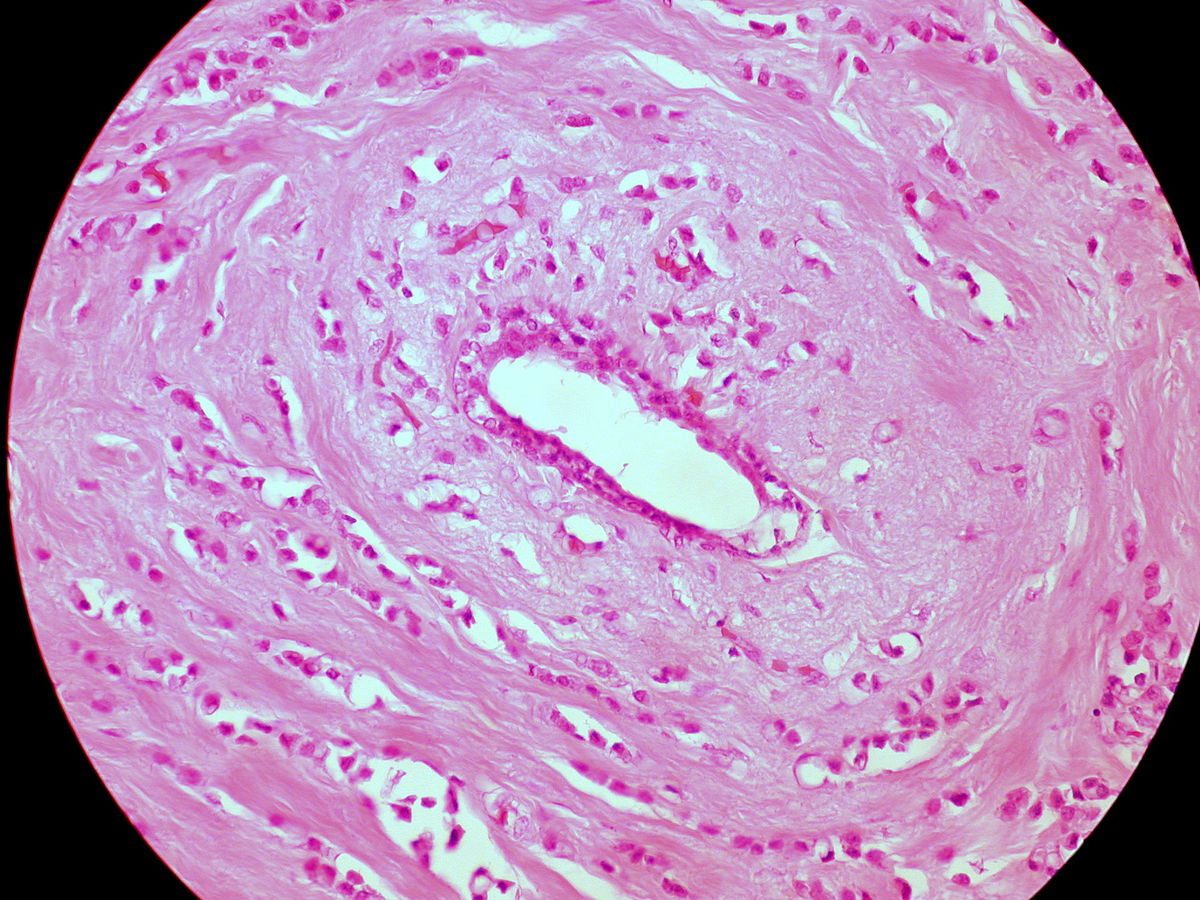 1200px-Classic_Invasive_Lobular_Carcinoma_of_the_Breast_(6813147194)